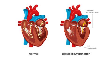 Left ventricular diastolic dysfunction 